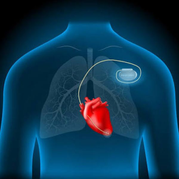 Pacemaker Implantation