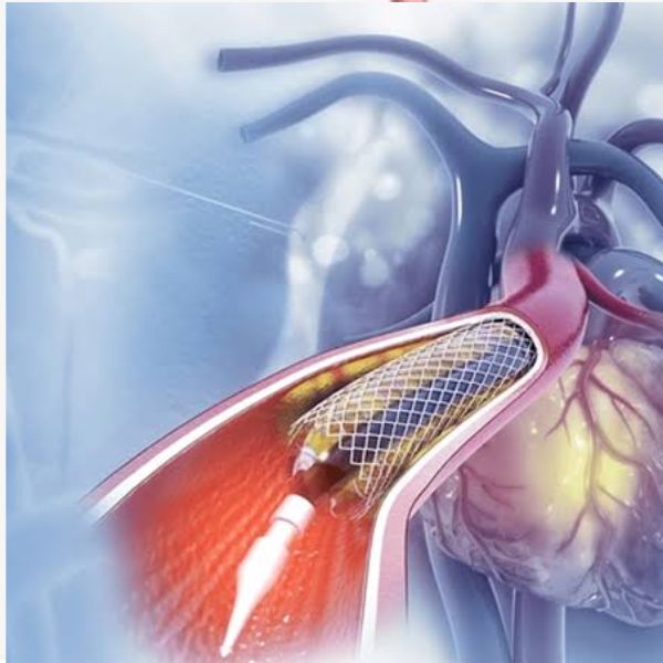 Complex Angioplasty