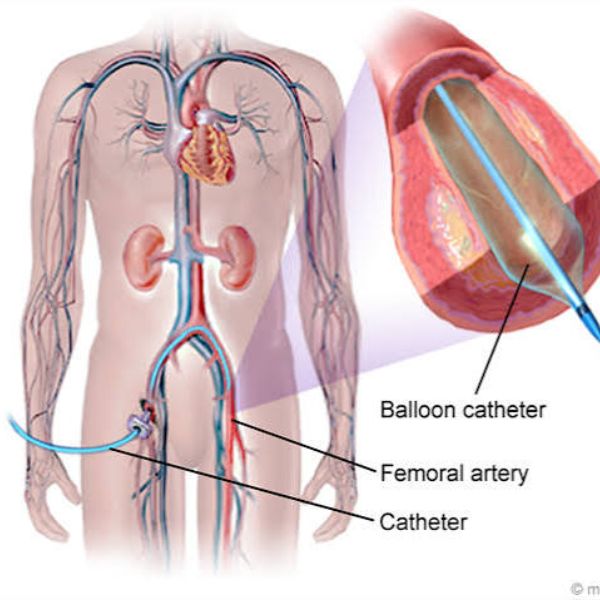 Peripheral Angioplasty