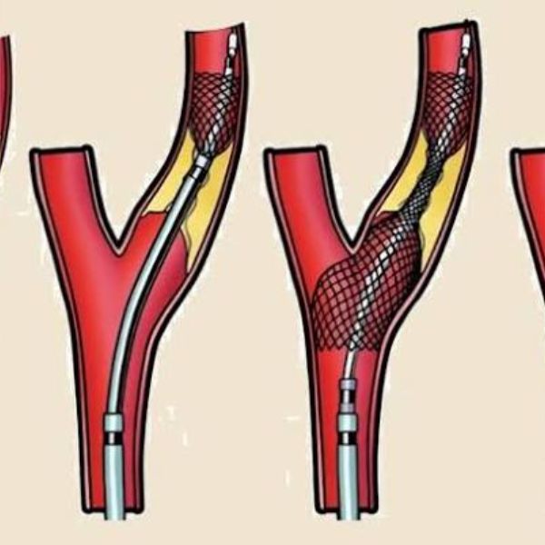 Carotid Angioplasty