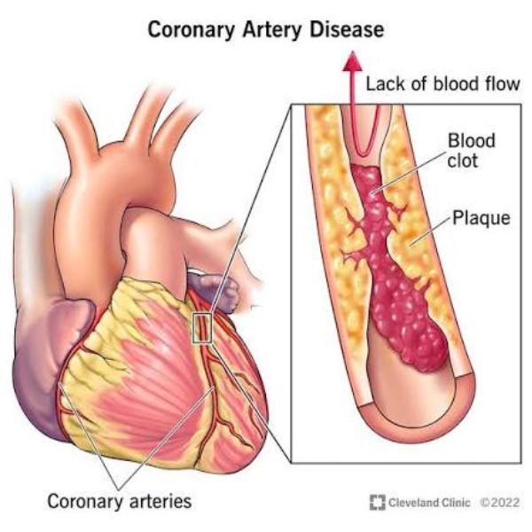 Coronary Artery Disease