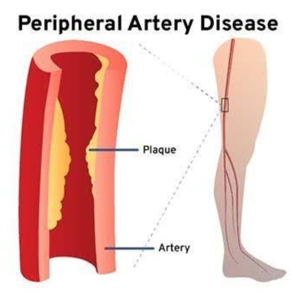 Peripheral Disease