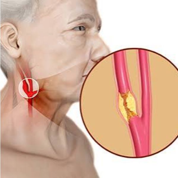 Carotid Disease