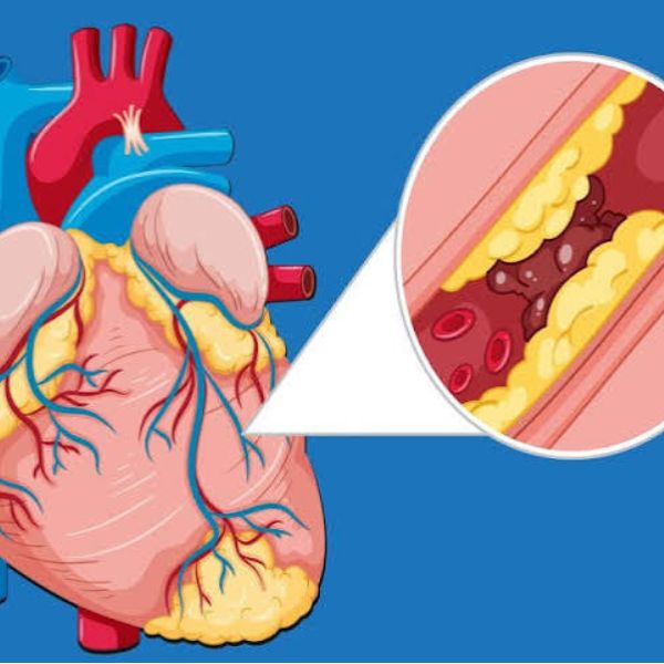 Heart Blockage Treatment