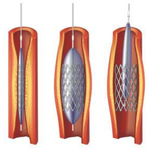Coronary Angioplasty