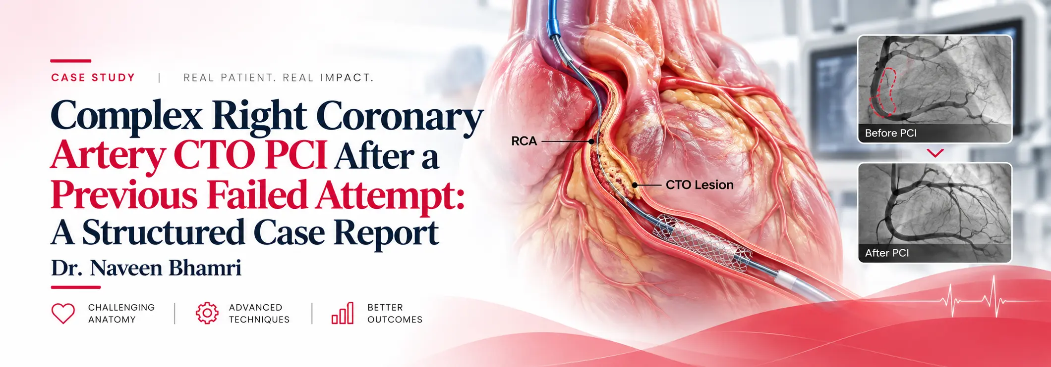 Complex Right Coronary Artery
